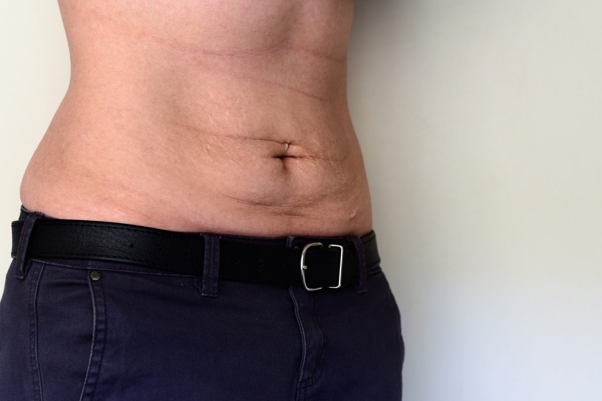 Skinny fat – co to jest? Jak poprawić wygląd sylwetki?